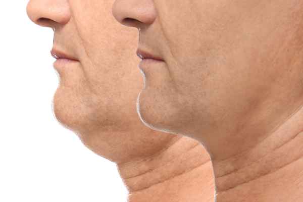 HIFU - Breakthrough in Anti - ageing 2 hifu results Arundel