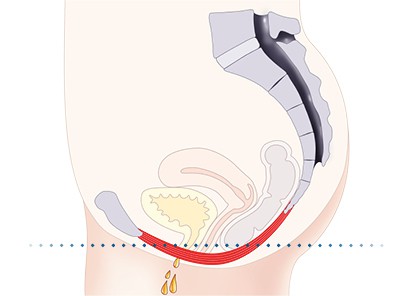 Pelvic-Floor Muscle Repair 5 Pelvic floor muscles Arundel