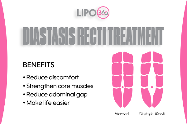 diastasis recti treatment Arundel