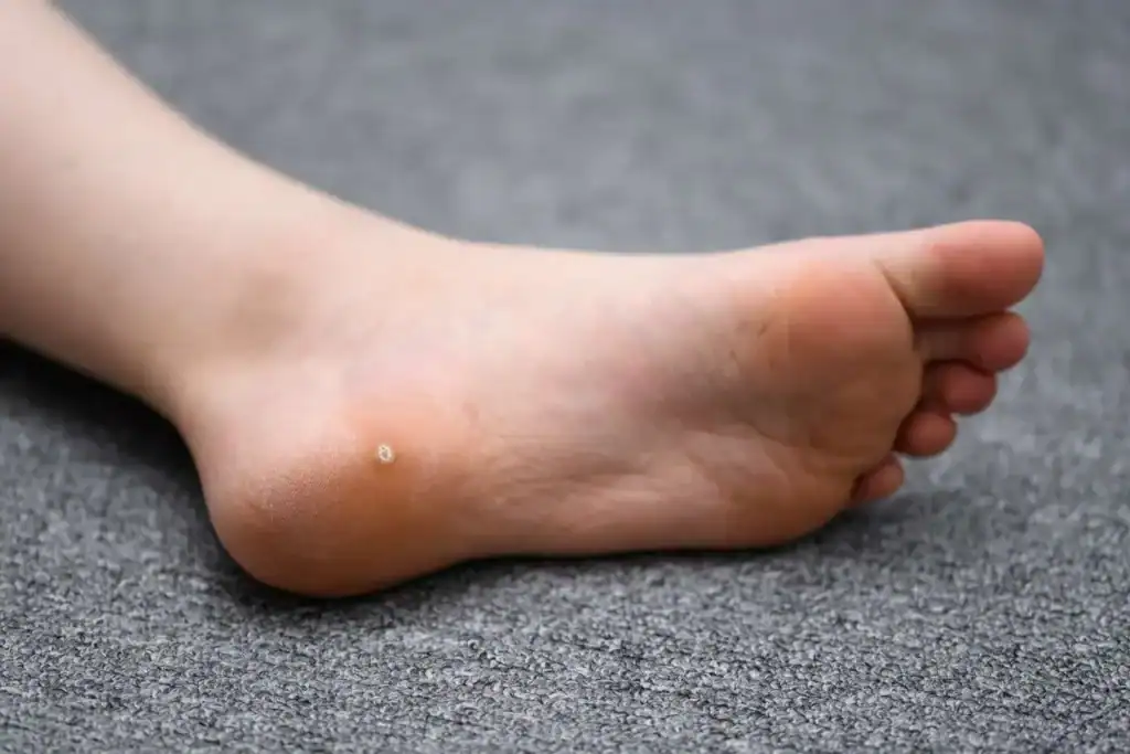 Cryotherapy For Warts And Also Verrucas 2 Image of verruca on the bottom of the foot that able to be treated with Cryotherapy Arundel