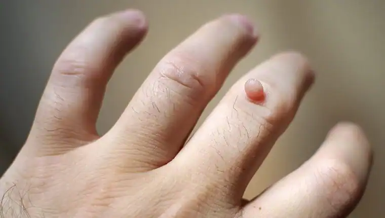 Image of blemish that Cryotherapy Arundel can remove with Lipo 360.