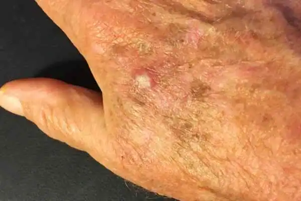 Image of Actinic keratoses Arundel on a person hand