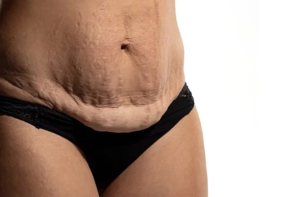 The science behind skin tightening Arundel picture of a woman's sagging skin on the stomach